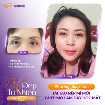 Cắt mí hỏng bao lâu sửa lại được? Những điều bạn cần biết