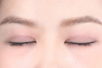 Cắt mí bị sẹo trắng: Nguyên nhân do đâu và cách xử lý hiệu quả