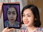 Cắt mí dưới bị trợn có khắc phục được không?