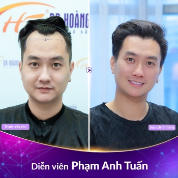 Cấy tóc tự thân có tốt không? Địa chỉ cấy tóc uy tín tại Hà Nội