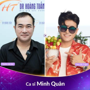 Cấy tóc tự thân được bao lâu? Có được vĩnh viễn không?