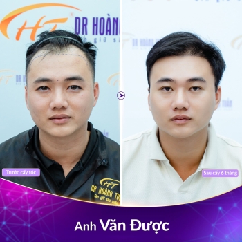 Hói chữ M nên để tóc gì để che khuyết điểm hiệu quả?