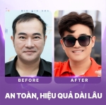 Liệu cấy tóc tự thân có hiệu quả không hay chỉ là quảng cáo?