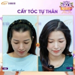 Cấy tóc tự thân có đau không? Trải nghiệm thực tế từ người đã làm