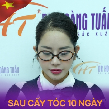 Hói đầu có chữa được không? Cập nhật công nghệ điều trị mới nhất
