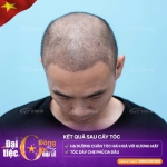 Hói đầu nam có nên cấy tóc tự thân không?