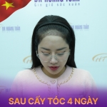 Quy trình cấy tóc tự thân và những lưu ý quan trọng sau thực hiện