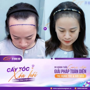 Bị hói đầu khi còn trẻ: Nguyên nhân do đâu và cách khắc phục hiệu quả