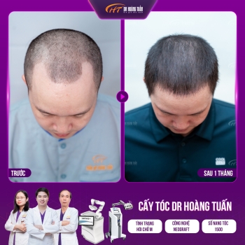 Cấy tóc chữa hói chữ M nam có hiệu quả không?