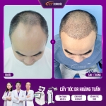 Hói chữ M do đâu? Nguyên nhân và cách cải thiện hiệu quả