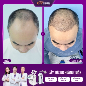 Hói chữ M do đâu? Nguyên nhân và cách cải thiện hiệu quả