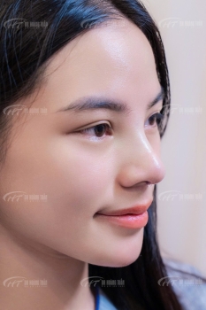 Độn cằm V-line: Bí quyết sở hữu gương mặt chuẩn tỉ lệ vàng