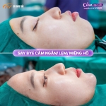 Độn cằm có cải thiện hô không? Sự thật bạn cần biết