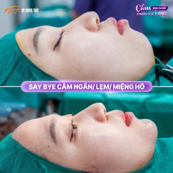 Độn cằm có cải thiện hô không? Sự thật bạn cần biết
