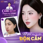 So sánh độn cằm và tiêm filler: Phương pháp nào phù hợp với bạn?