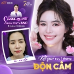 Độn cằm có được vĩnh viễn không? Yếu tố quyết định thời gian duy trì