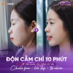 Độn cằm lẹm: Cải thiện dáng cằm ngắn, lẹm hiệu quả
