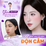 Sửa cằm lẹm giúp thay đổi đường nét gương mặt như thế nào?