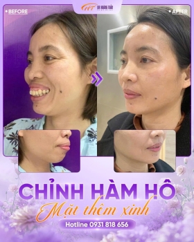 Chỉnh hàm hô giá bao nhiêu? Các yếu tố ảnh hưởng đến chi phí
