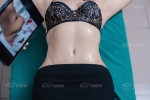Hút mỡ bụng có bị béo lại không? Nguyên nhân và cách phòng ngừa