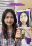Mở góc mắt bao lâu thì hết sưng? Thời gian hồi phục chi tiết