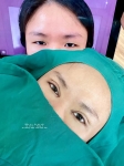 Mở góc mắt có để lại sẹo không? Những điều cần biết trước khi thực hiện