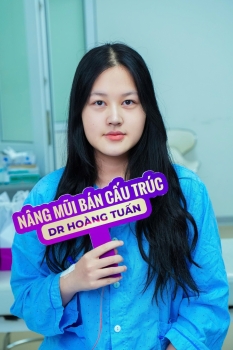 Nâng mũi bán cấu trúc bao lâu tháo nẹp?