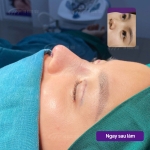 Nâng mũi mấy ngày hết sưng và đẹp tự nhiên?