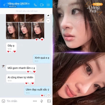 Các feedback nâng mũi của khách hàng thực tế tại Dr Hoàng Tuấn