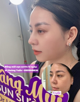 Nâng mũi sụn sườn có tốt không? Địa chỉ nâng mũi uy tín