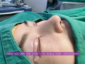 Bác sĩ Dr Hoàng Tuấn giải đáp: Nâng mũi sụn sườn có đau không?