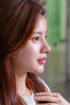 Nâng mũi sụn sườn giữ được bao lâu? Liệu có được vĩnh viễn không?