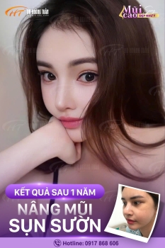 Nâng mũi sụn sườn bao lâu thì đẹp?