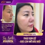 Nâng mũi bị lộ sóng do đâu? Khi nào cần can thiệp?