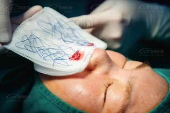 Nâng mũi bằng chỉ có an toàn không? Dr Hoàng Tuấn giải đáp chi tiết