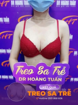 Nâng ngực sa trễ không đặt túi|Dr Hoàng Tuấn