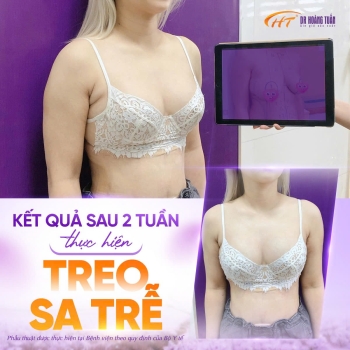 Treo ngực sa trễ giữ được bao lâu? Liệu có bị chảy xệ hay không?