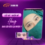 Nhấn mí lỗi bao lâu thì sửa được? Giải đáp chi tiết