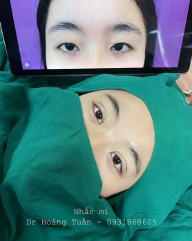 Nhấn mí 1 bên được không? Giải đáp chi tiết từ chuyên gia