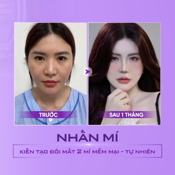Nhấn mí bao nhiêu ngày hết sưng? Chăm sóc mắt sau khi nhấn mí