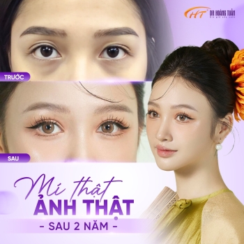 Nhấn mí lấy mỡ mắt là gì? Có nên thực hiện không?