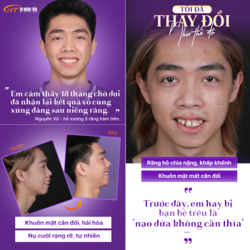 TÔI ĐÃ THAY ĐỔI NHƯ THẾ ĐÓ: Hà Lê Nguyên Vũ - Hành trình tìm lại nụ cười và sự tự tin tuổi đôi mươi tại Dr. Hoàng Tuấn