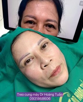 Treo cung mày có đau không? Giải đáp từ bác sĩ và trải nghiệm thực tế của khách hàng