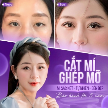 Ghép mỡ mí mắt là gì? Bác sĩ giải thích đúng kỹ thuật để bạn hiểu rõ trước khi làm