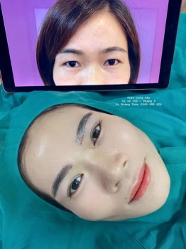 Treo cung mày kiêng ăn gì để hạn chế sưng và sẹo?