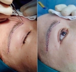 Nâng cung mày bao lâu thì hết sẹo? Những yếu tố ảnh hưởng