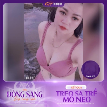 Treo sa trễ không đặt túi có đẹp không? Hình dáng vòng 1 sau phẫu thuật