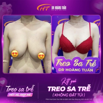 Treo sa trễ không đặt túi giá bao nhiêu? Những yếu tố quyết định chi phí