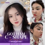 Gọt hàm nghỉ dưỡng bao lâu? Bao lâu có thể trở lại sinh hoạt bình thường?