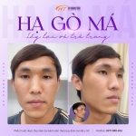 Gò má cao có nên phẫu thuật không? Bác sĩ phân tích chi tiết để bạn chọn đúng